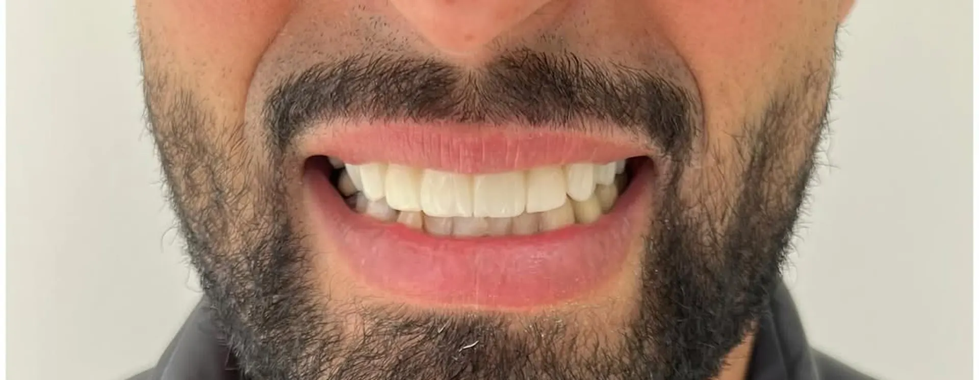 Dents abîmées et irrégulières, après