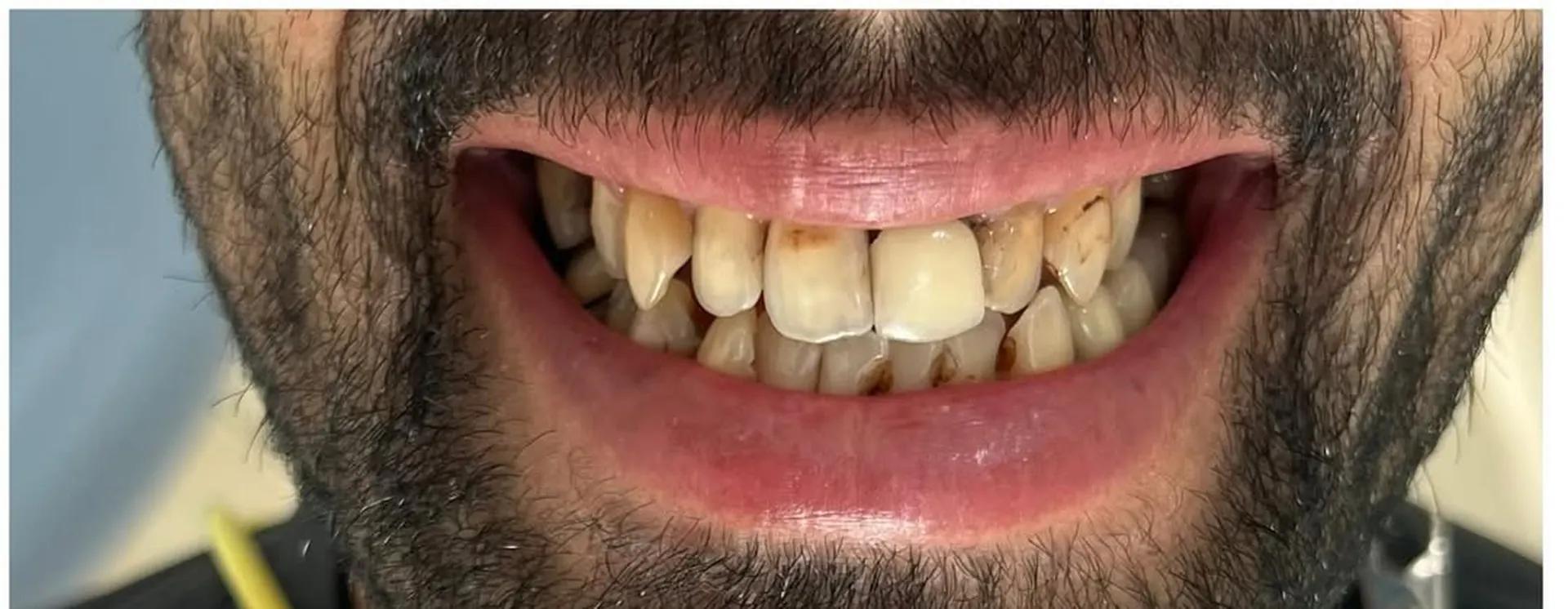 Dents abîmées et irrégulières, avant