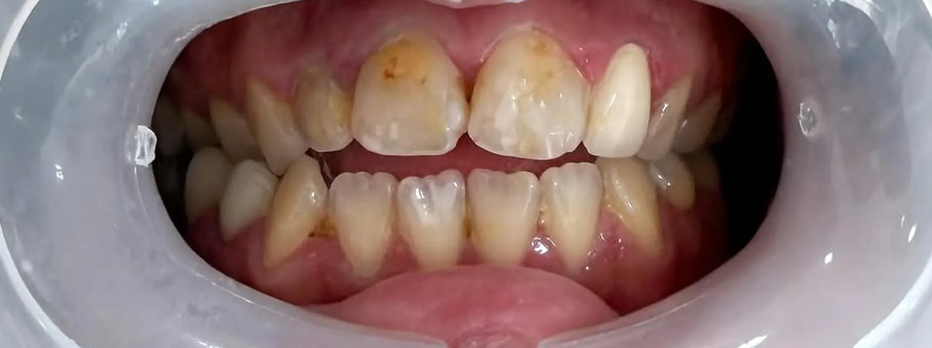 Esthétique du sourire, avant