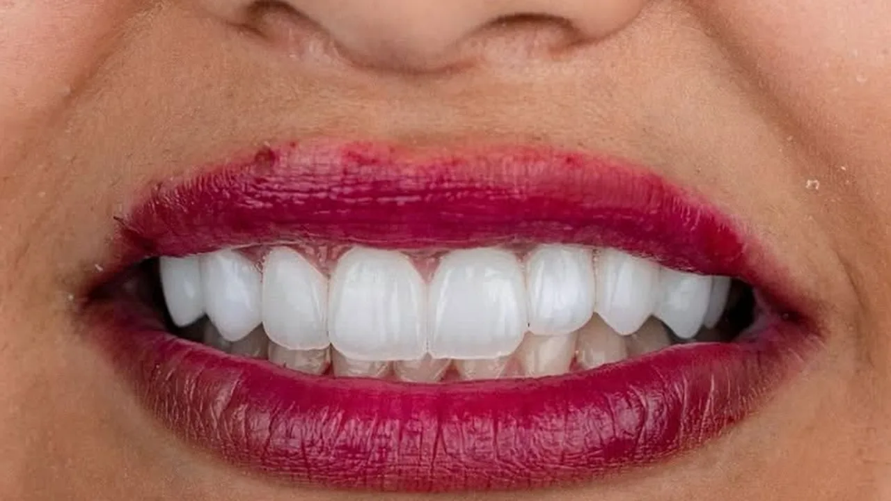 Dents jaunies et cassées, après