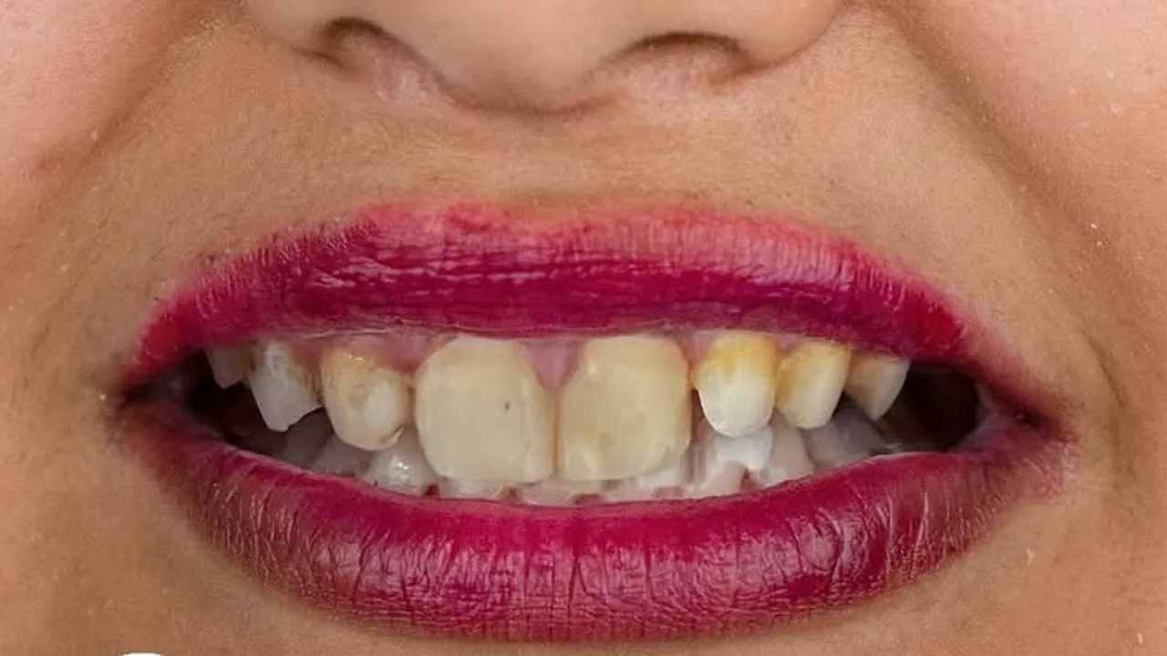 Dents jaunies et cassées, avant