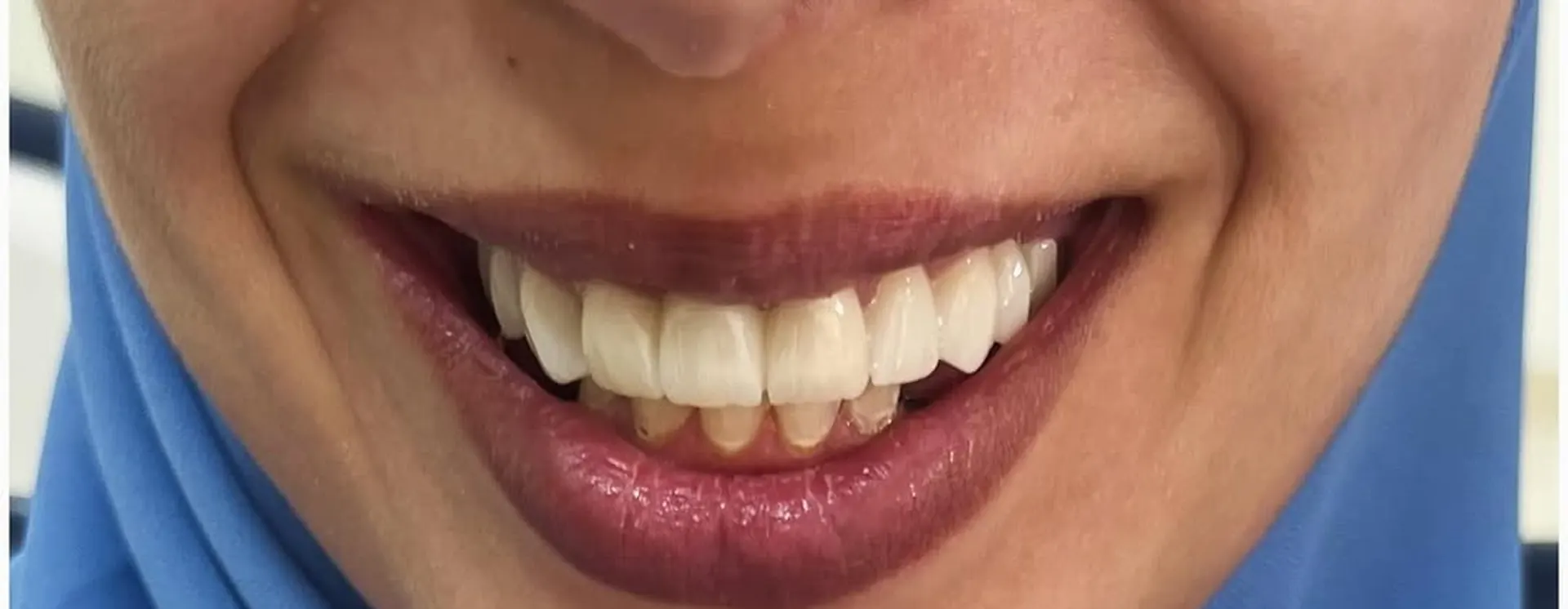 Dents cassées et manquantes, après