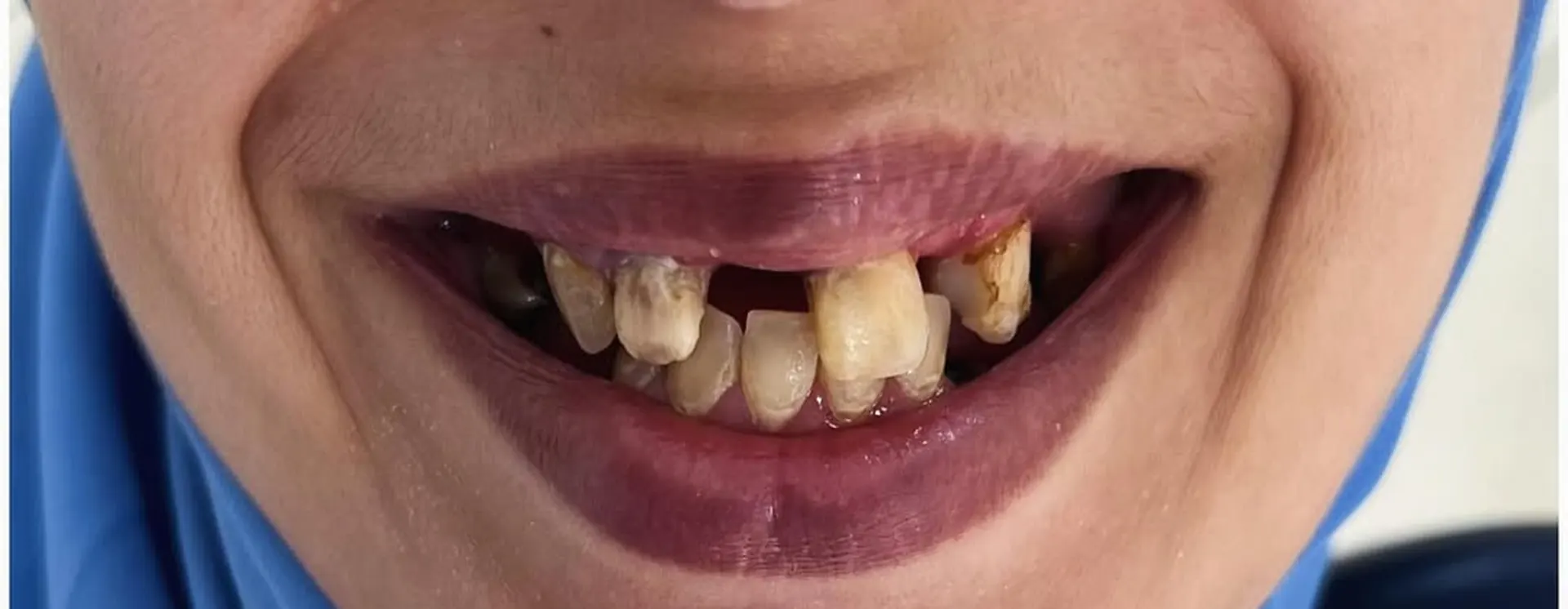 Dents cassées et manquantes, avant